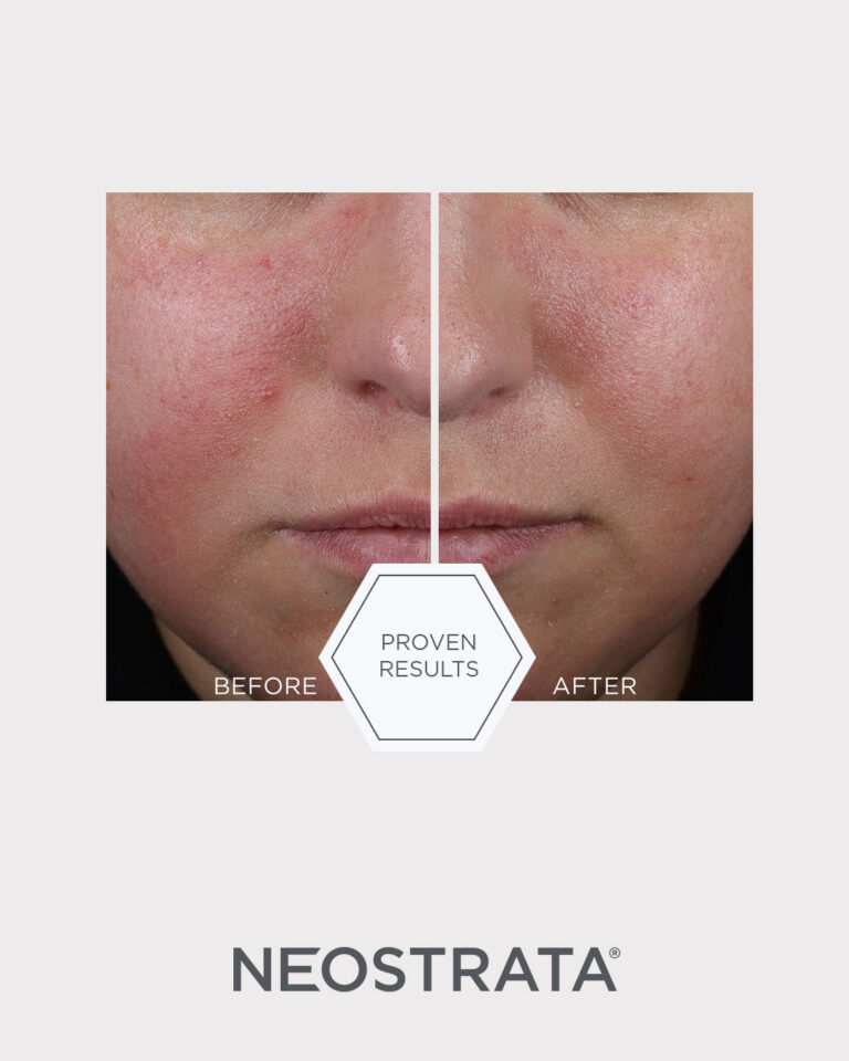 Billede til sociale medier NEOSTRATA Mandelic Clarifying Hydragel 1