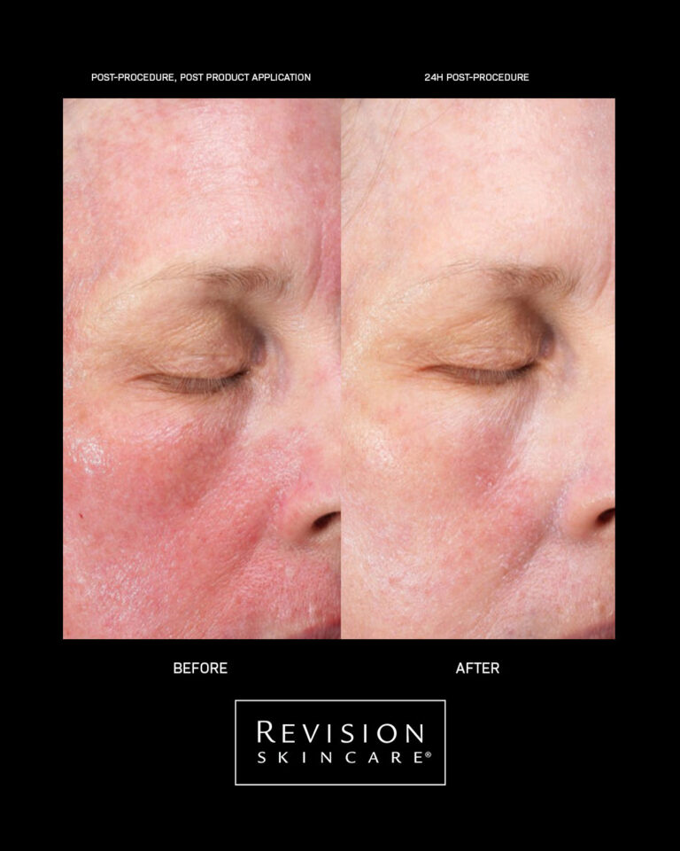 Billede til sociale medier Revision Skincare CMT results