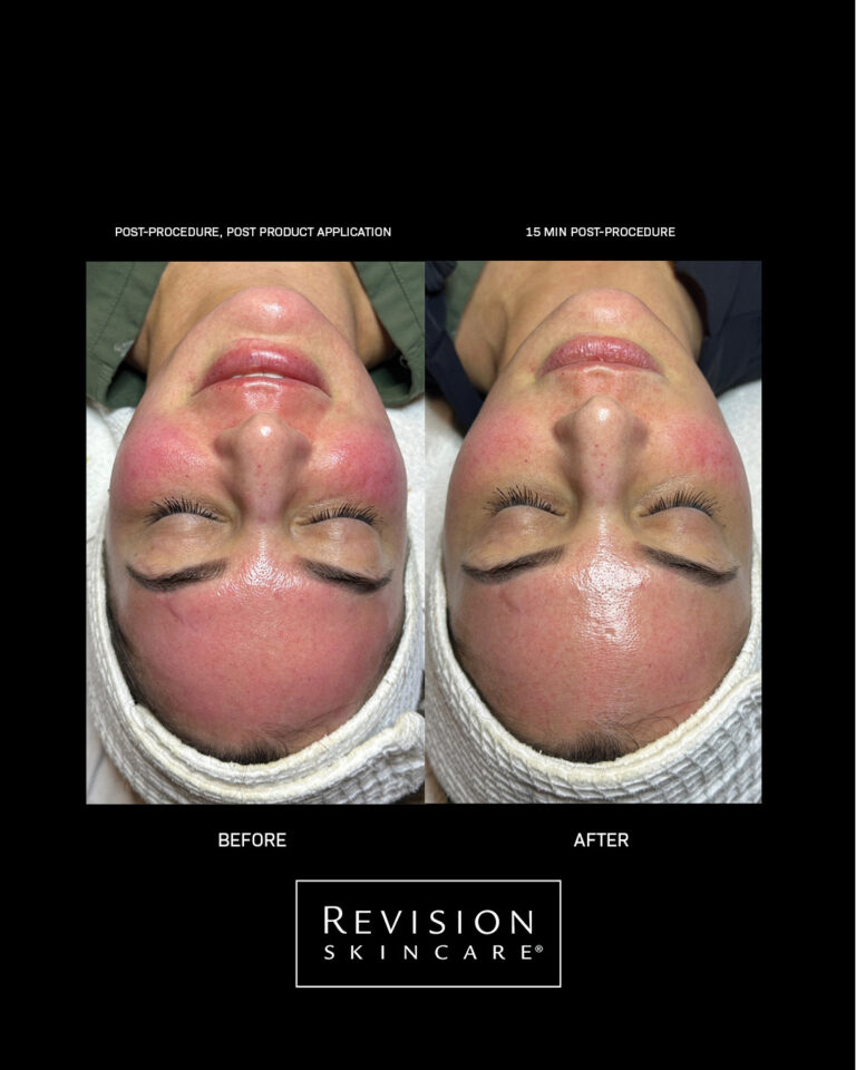 Billede til sociale medier Revision Skincare CMT results